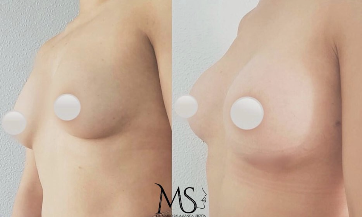 Aumento de pechos: antes y después