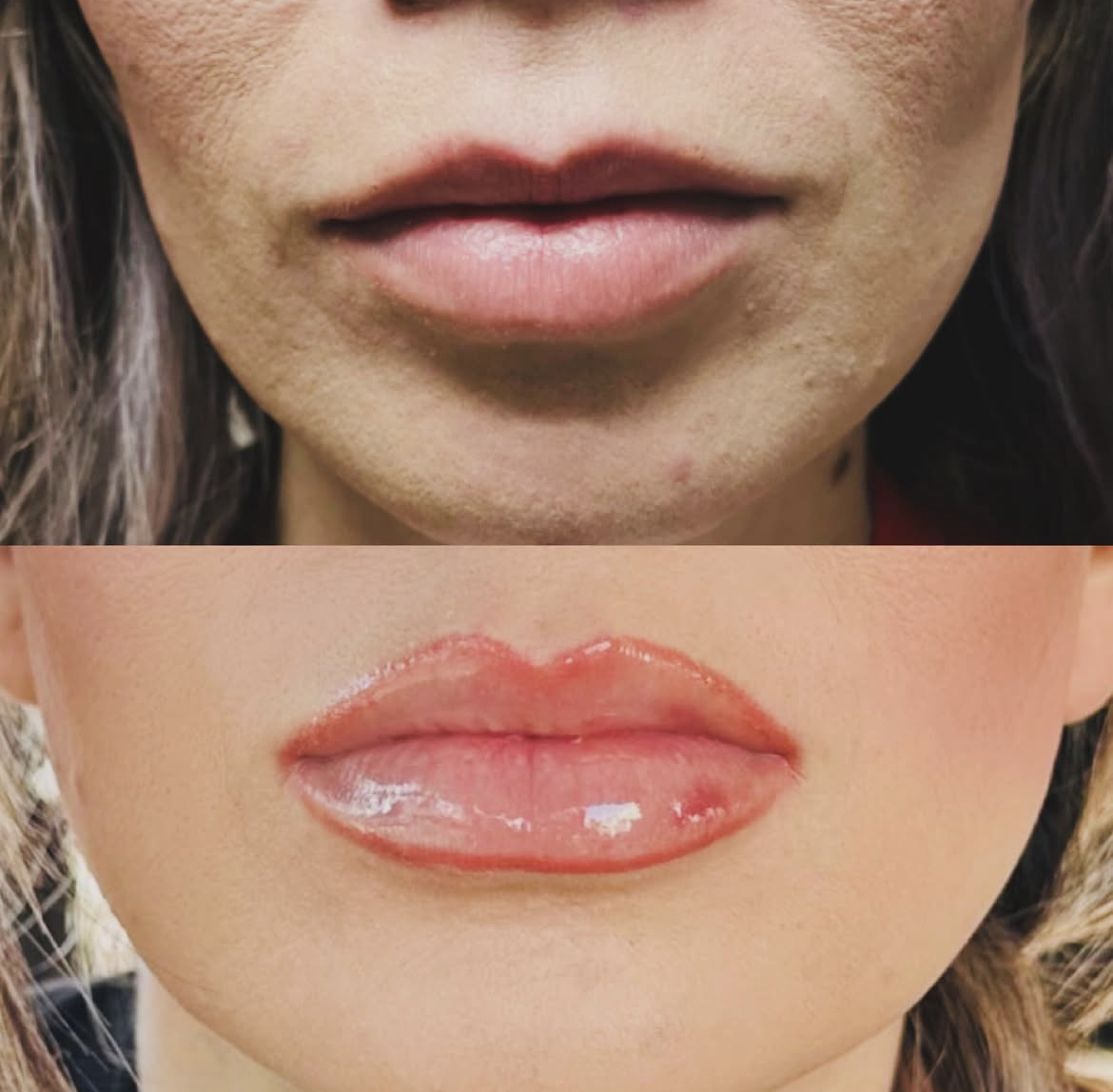 Relleno de labios: antes y después