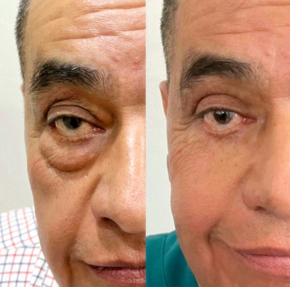 otoplastia reconstructiva