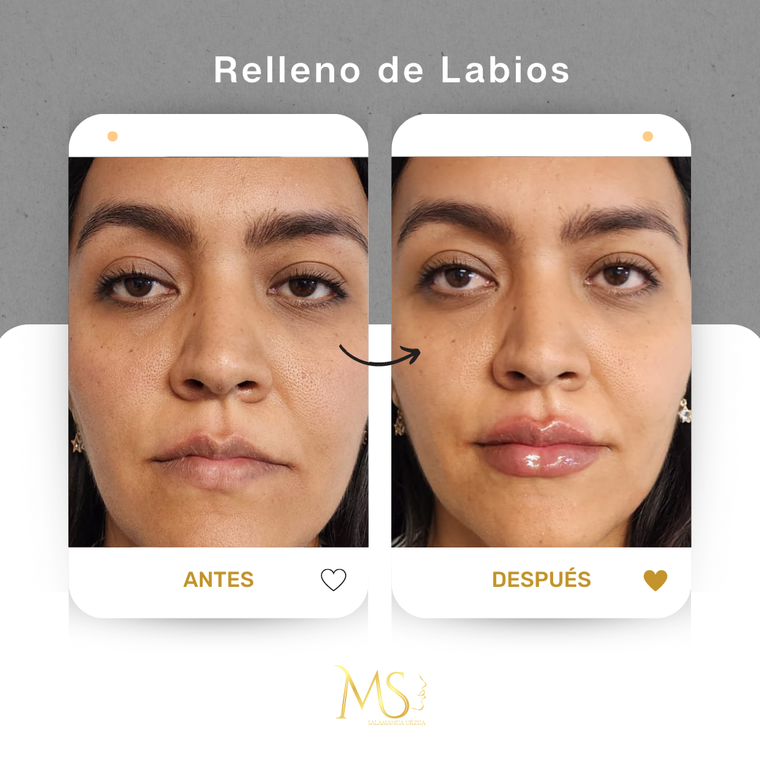 Relleno de labios: antes y después