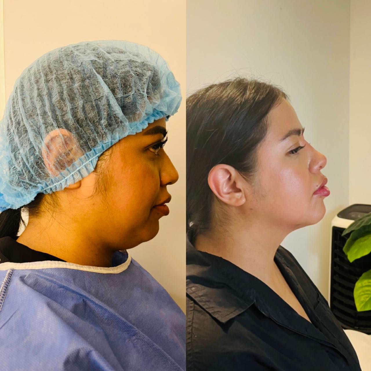 otoplastia reconstructiva